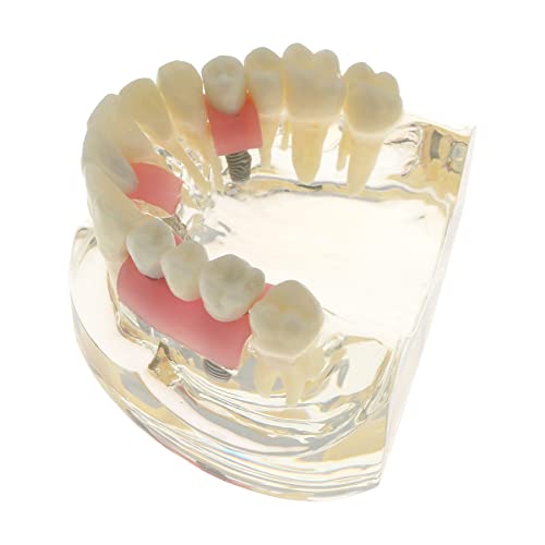 Заби за заби за заби модел Демо 4 импланти мост абјутмент предозирање со типодонт реставрација студија Научи демо меки гингива круни