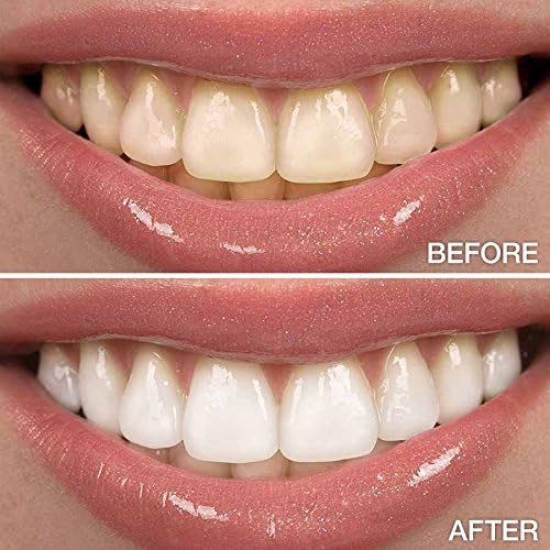 Пенка за белење на заби од Новашин, 2мл 6% водород пероксид, до 15 третмани за белење