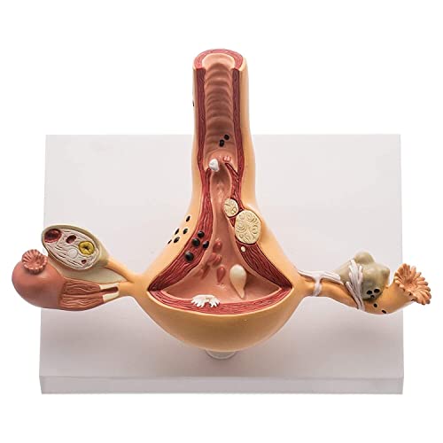 Спанкаре Матка И Јајници Женски Репродуктивен Орган Анатомски Модел Вообичаени Абнормалности