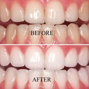 Природна елеганција нане зачинето на домашни заби Белење префилирани фиоки, 7 горни и 7 пониски за 7 дена белење, драматично професионално белител, намалена чувстви?