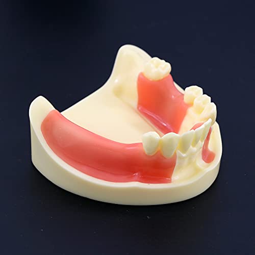 Заби за заби на типодонт модел на имплантација практика за преголема реставрација Демо за студии Научете пониска вилица отстранлива