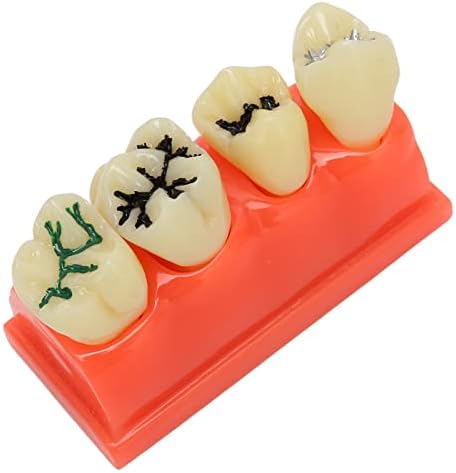 Скршен модел на заби Модел на расипување на забите Образовна структура за стоматолошка болница за ваша демонстрација